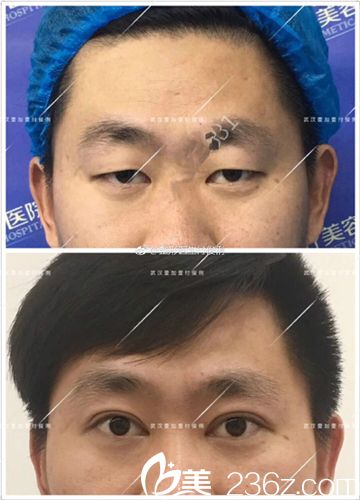 武漢壹加壹雙眼皮真人對比實例