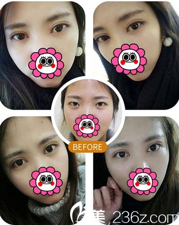 武漢美立方雙眼皮對比實例