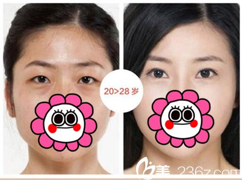 武漢卓美雙眼皮實例