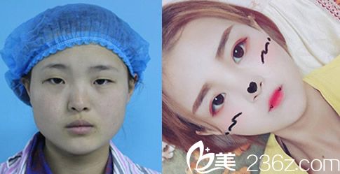 臺(tái)美麗格院長(zhǎng)葉凡眼綜合整形案例 臺(tái)美麗格院長(zhǎng)葉凡眼綜合整形案例