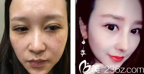 葉凡耳軟骨復(fù)合隆鼻案例 葉凡耳軟骨復(fù)合隆鼻案例