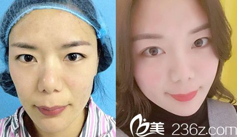 葉凡自體脂肪填充全臉案例效果對(duì)比圖 葉凡自體脂肪填充全臉案例效果對(duì)比圖