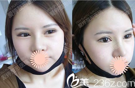 韓國愛婷整形假體隆鼻和磨顴骨一個月照