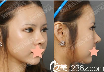 韓國愛婷整形醫(yī)院做雙眼皮修復(fù)+無疤痕隆鼻+磨顴骨三個月照