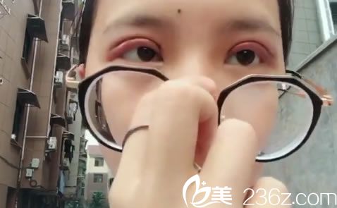 在金華瑞麗做雙眼皮3天后