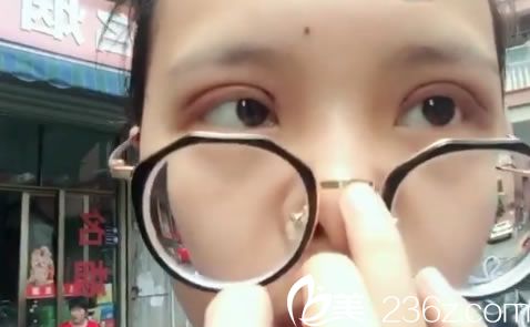 選擇金華瑞麗劉政割雙眼皮7天效果