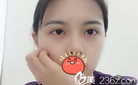 相信看了我在金華瑞麗找劉政院長做雙眼皮和開眼角的恢復效果,你也會想割雙眼皮的