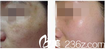 祛除黃褐斑前后對(duì)比
