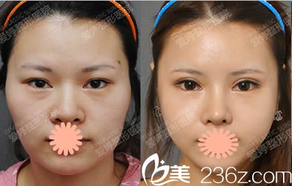 韓國(guó)愛婷整形醫(yī)院好嗎?請(qǐng)看我做完雙眼皮失敗修復(fù)/隆鼻/磨顴骨的案例分享