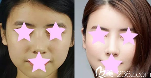 自體肋軟骨隆鼻代表案例