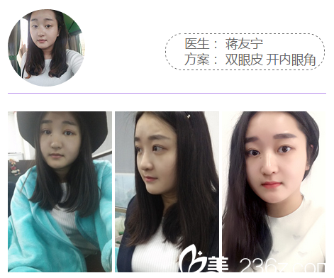 梅州曙光蔣友寧做的全切雙眼皮案例 梅州曙光蔣友寧做的全切雙眼皮案例