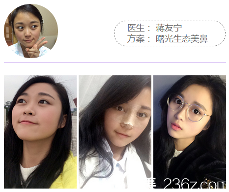 梅州曙光整形醫(yī)院蔣友寧做的隆鼻案例對(duì)比圖 梅州曙光整形醫(yī)院蔣友寧做的隆鼻案例對(duì)比圖