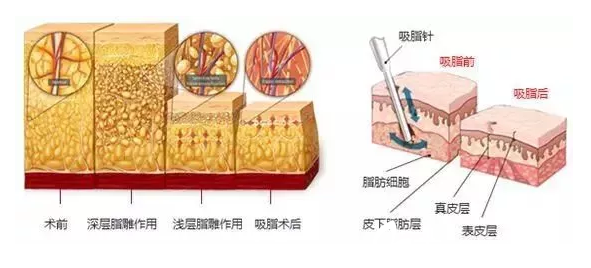 吸脂減肥效果圖