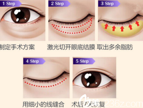 激光祛眼袋過程示意圖