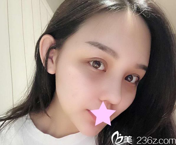 全臉脂肪填充半個月效果 全臉脂肪填充半個月效果