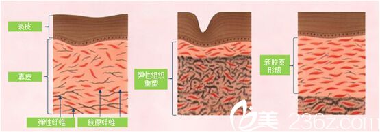 激光改善陰道緊縮效果圖 激光改善陰道緊縮效果圖