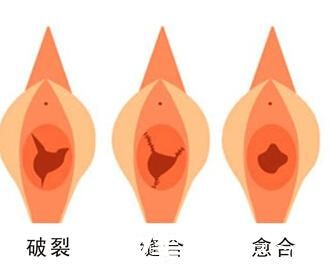 處女膜修復(fù)術(shù)效果圖 處女膜修復(fù)術(shù)效果圖