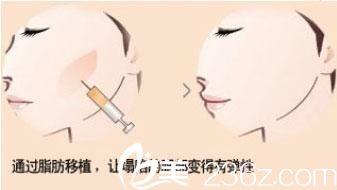 自體脂肪豐蘋果肌