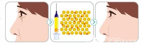 自體脂肪豐蘋果肌多久自然