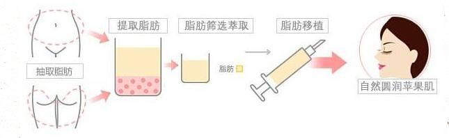 自體脂肪豐蘋果肌存活率