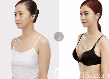 西安美萊醫(yī)學美容醫(yī)院自體脂肪豐胸案例