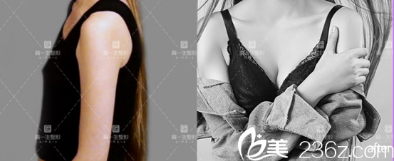 西安高一生醫(yī)療美容醫(yī)院自體脂肪豐胸案例