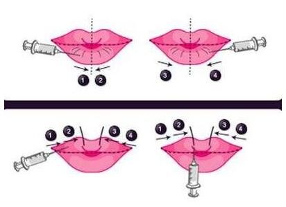 注射豐唇的方式