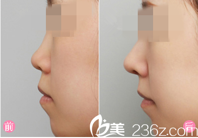 膨體隆鼻手術(shù)前后對比圖