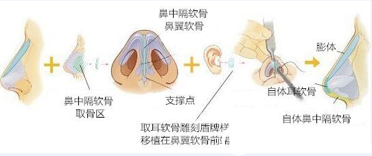 鼻綜合整形原理
