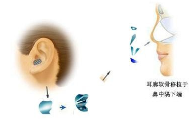 耳軟骨隆鼻手術(shù)