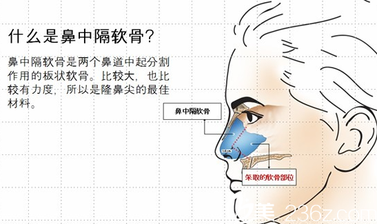 鼻中隔軟骨取出位置