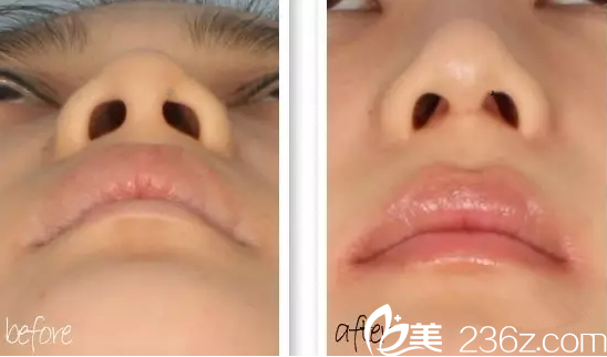 膨體隆鼻前后對比