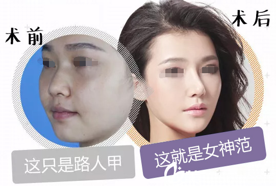 鼻中隔軟骨隆鼻案例