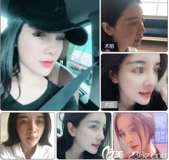 肋軟骨修復(fù)鼻整形失敗案例