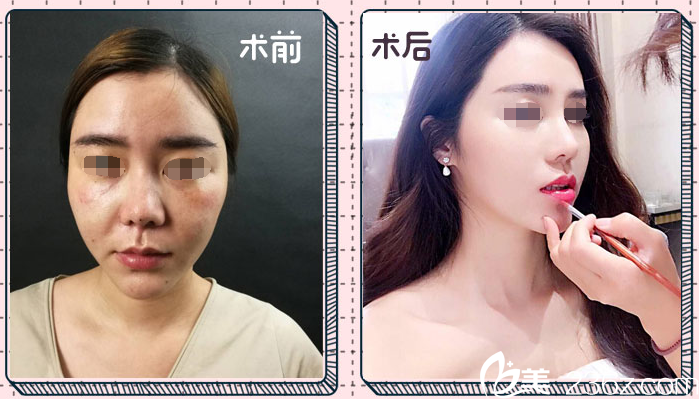 耳軟骨塑造鼻尖整形案例