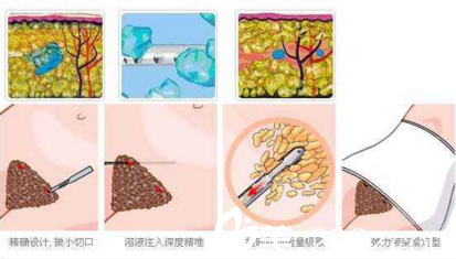 腰腹吸脂過程圖