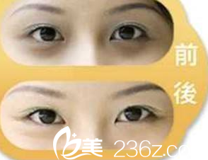 激光祛黑眼圈前后效果對比