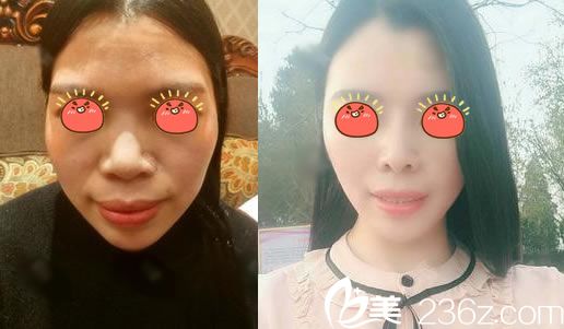 注射玻尿酸除皺案例效果