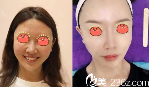 注射瘦臉除皺除皺案例效果