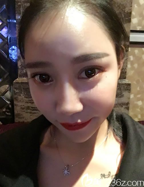 做完面部埋線提升術(shù)后7天效果圖 做完面部埋線提升術(shù)后7天效果圖