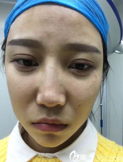 在寧波童顏依美做線雕手術(shù)前 在寧波童顏依美做線雕手術(shù)前