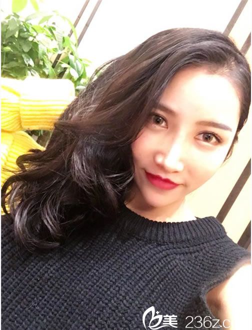 在看了寧波童顏的很多面部線雕案例效果后,我終于下定決心去做埋線提升了