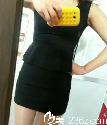 術(shù)后30天腰部明顯變瘦 術(shù)后30天腰部明顯變瘦