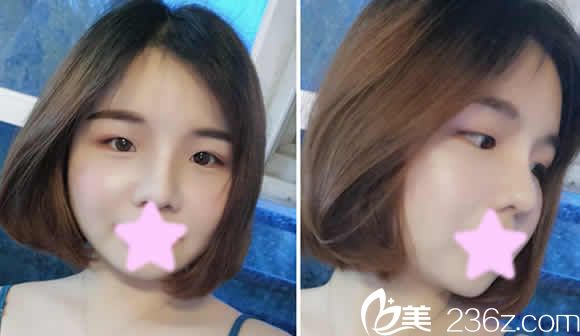 看著自己在太原華美整形做超皮秒祛斑10天變化圖片，我真被這效果驚到了