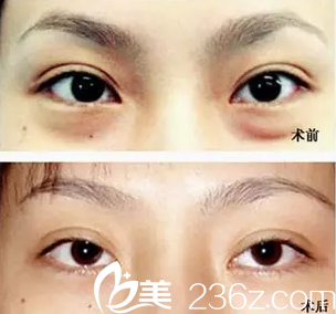 激光祛黑眼圈效果