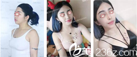 重慶銅雀臺李信奎自體脂肪豐胸案例 重慶銅雀臺李信奎自體脂肪豐胸案例