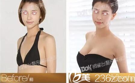 重慶銅雀臺<!--<i data=20240703-sp></i>-->自體脂肪隆胸案例 重慶銅雀臺<!--<i data=20240703-sp></i>-->自體脂肪隆胸案例