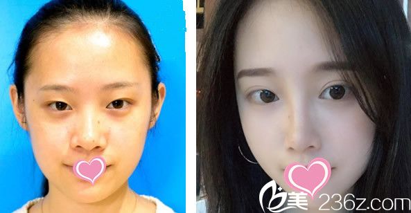 包頭華美玻尿酸隆鼻整形效果案例