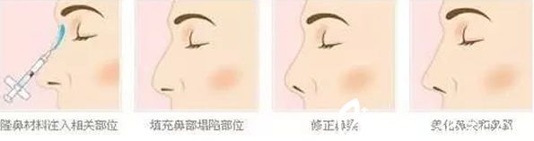 玻尿酸隆鼻的作用