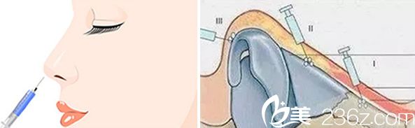 玻尿酸隆鼻適合少量多次注射